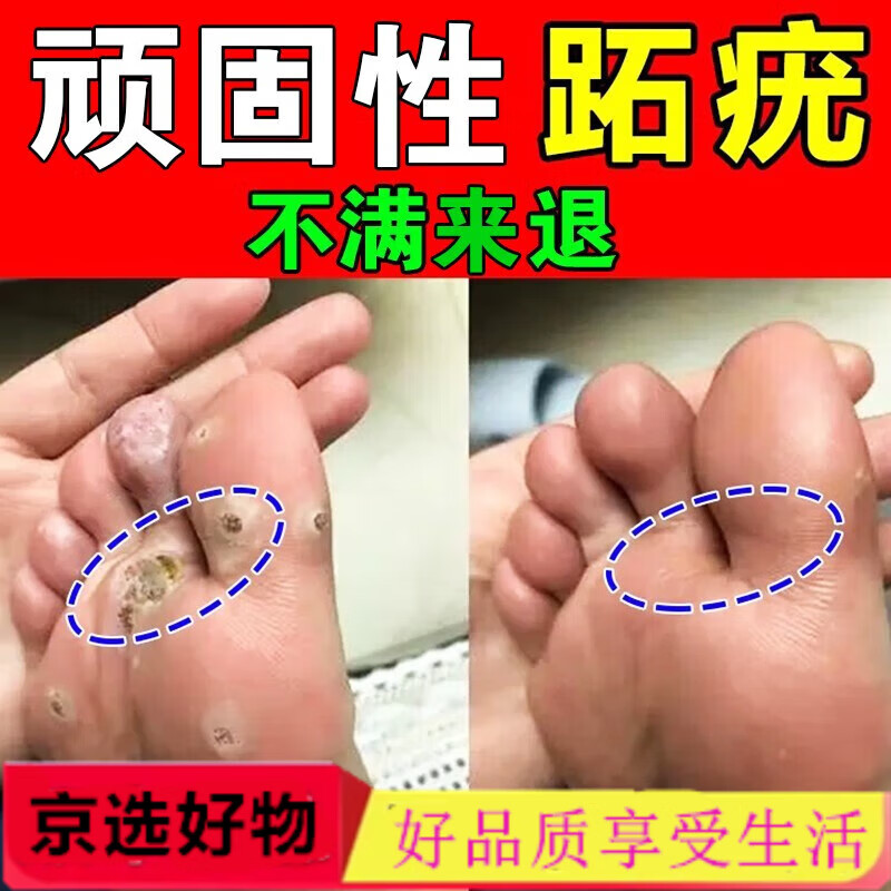 跖疣脚底趾疣去专门用刺猴官方老茧丝状疣扁平疣抗 1盒装轻微重症