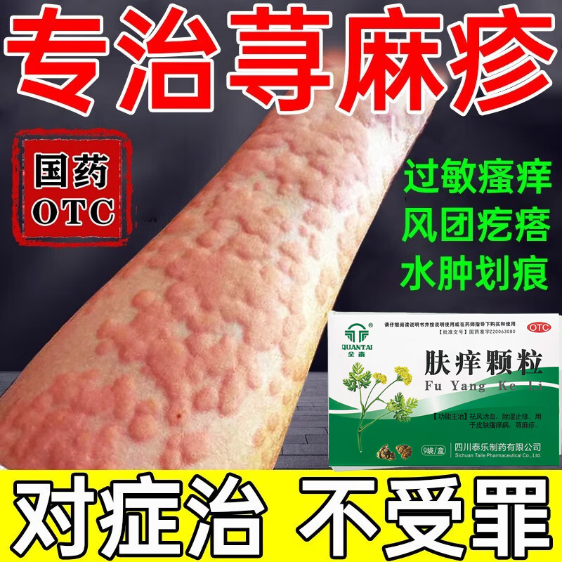荨麻疹过敏止痒断方根荨麻疹专用otc药肤痒颗粒 治疗荨麻疹特痒皮肤