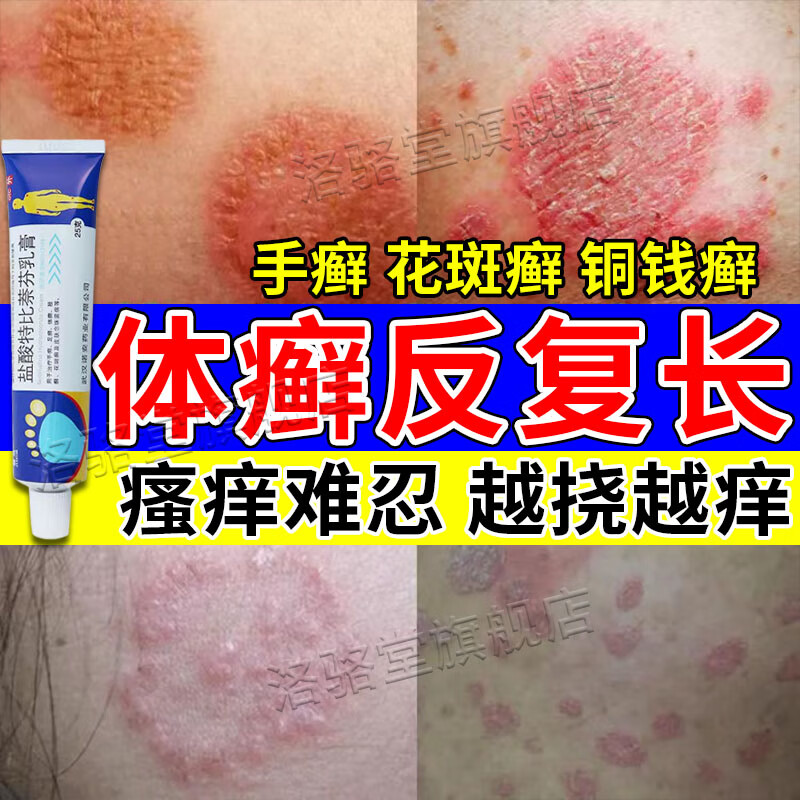 铜钱癣专用otc药膏治真菌感染皮肤瘙痒脱皮红斑越挠越痒头癣体癣手癣