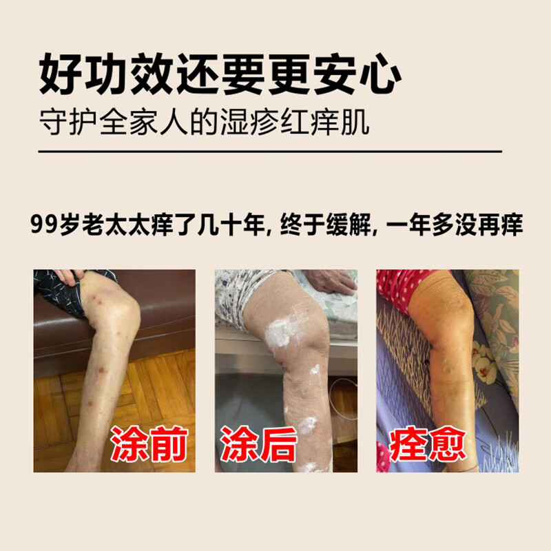 善维湿疹粉1小时强力止痒 顽固湿疹反复汗疱疹 私处肛周搔痒 无激素 湿疹粉1盒+保湿软膏