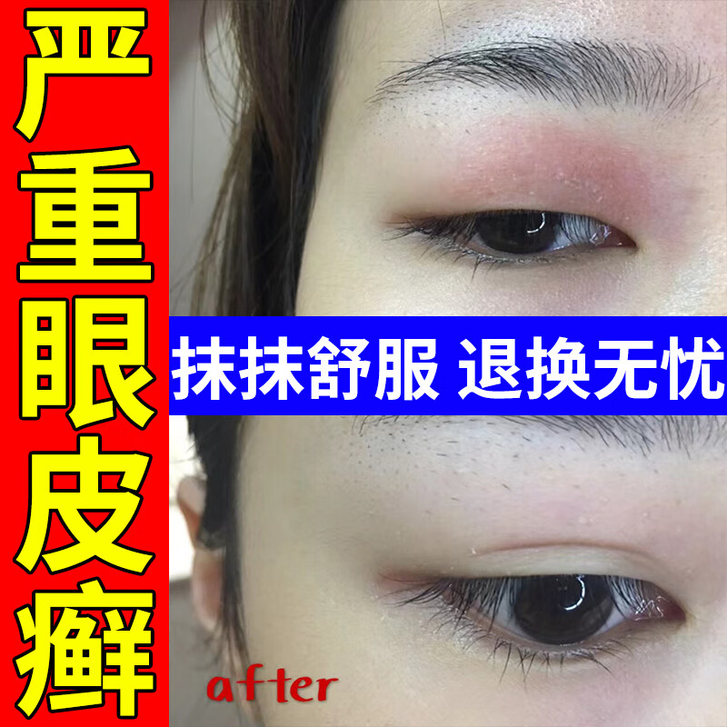 京东官方旗舰店自营眼皮癣 眼皮红肿痒过敏干燥 消肿眼睛周围过敏眼角