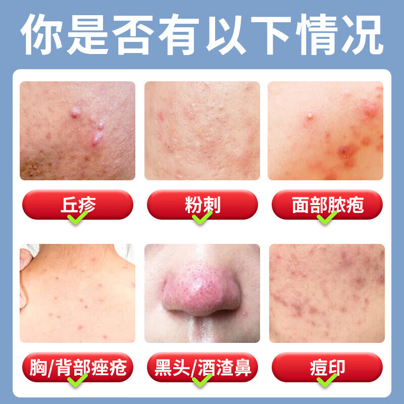 北京同仁堂 痤疮膏重度暗疮男女初中生腮边青春痘脸上额头下巴起小疙瘩痤疮膏专用痤疮凝胶 三盒装【买2送1】