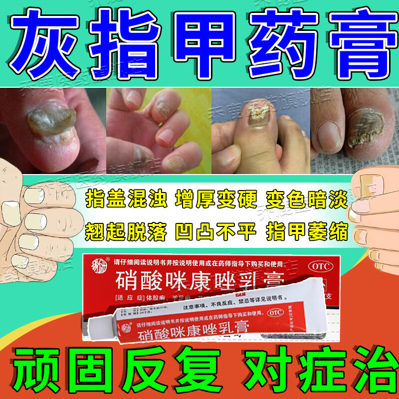 治手脚灰指甲药膏指甲真菌感染脱甲增厚发黄变空液凹凸有坑分层翘起