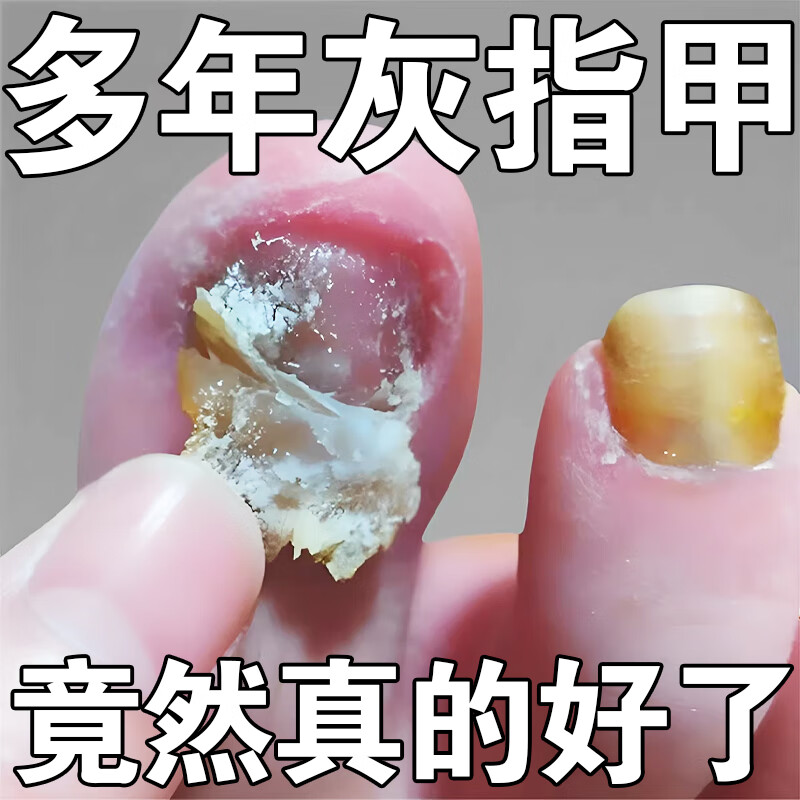 根效治指甲真菌感染脱甲坏甲正品灰甲清脚指甲增厚去除抑菌艮治正膏药