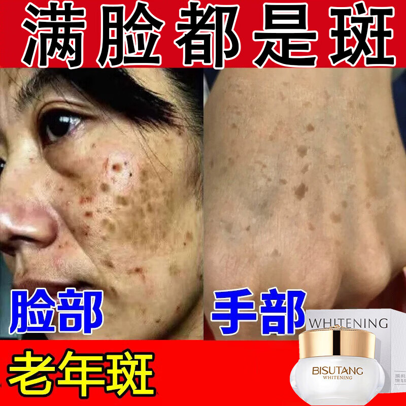 安安金纯(agensn)老年斑专用脸部霜男士女士专i用色i斑黑色素 单盒