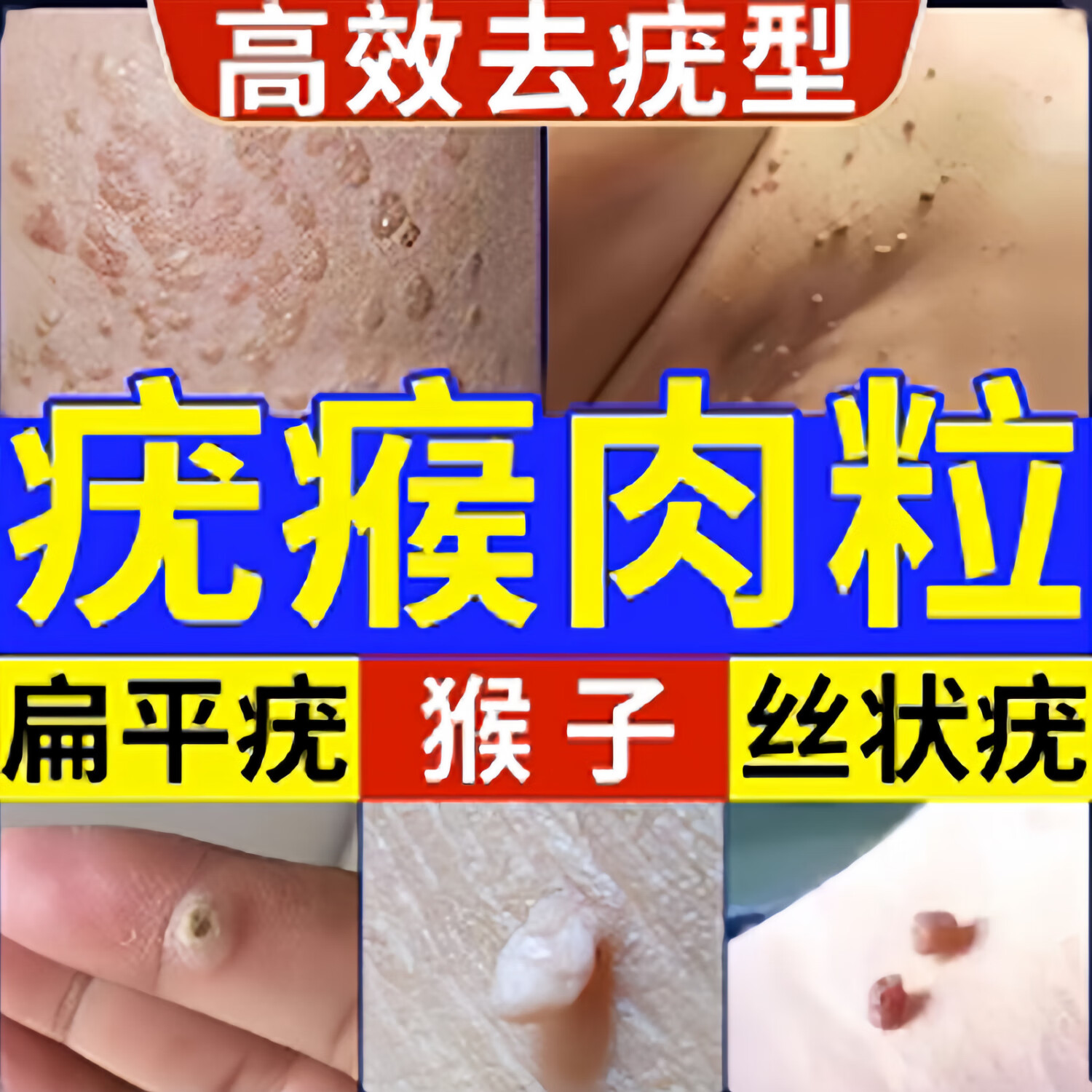 扁平疣面部药瘊子小肉粒疙瘩猴子去除丝状疣跖疣祛疣膏一抹灵皮肤用药