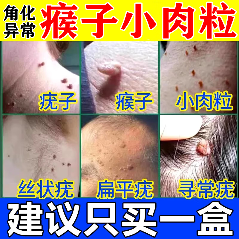 维a酸乳膏治扁平疣专用药膏面部脖子去用瘊子肉粒疙瘩除的小肉粒猴子
