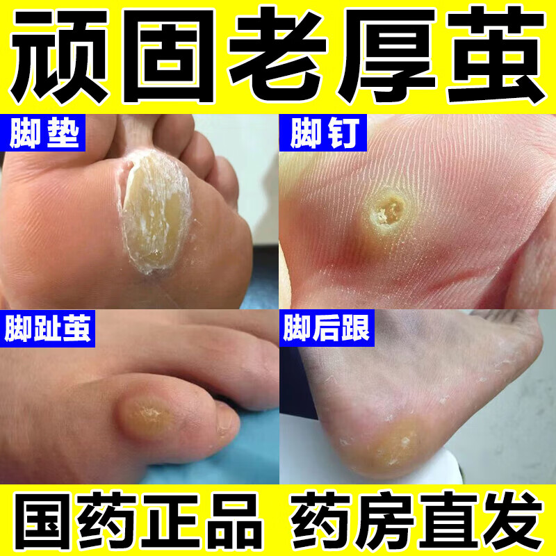 �ϼ����������ȥ���ŵ��ϼ�ȥӲƤ��������ȥ��Ƥ�ϼ�ŵ׺�����Ƥ�ź��ӲƤ��������Ƥ����ҩˮ�������� 5��װ�������ϼ� ����Ӳ�� һ�߾��ۡ���һ����һ��