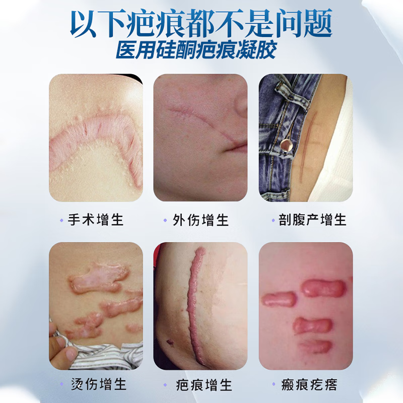 葵花 防增生疤痕贴疤痕增生凸起去除疙瘩止痒烫伤去疤恢复贴缝针术后 三盒【买2送1】疤痕修复凝胶