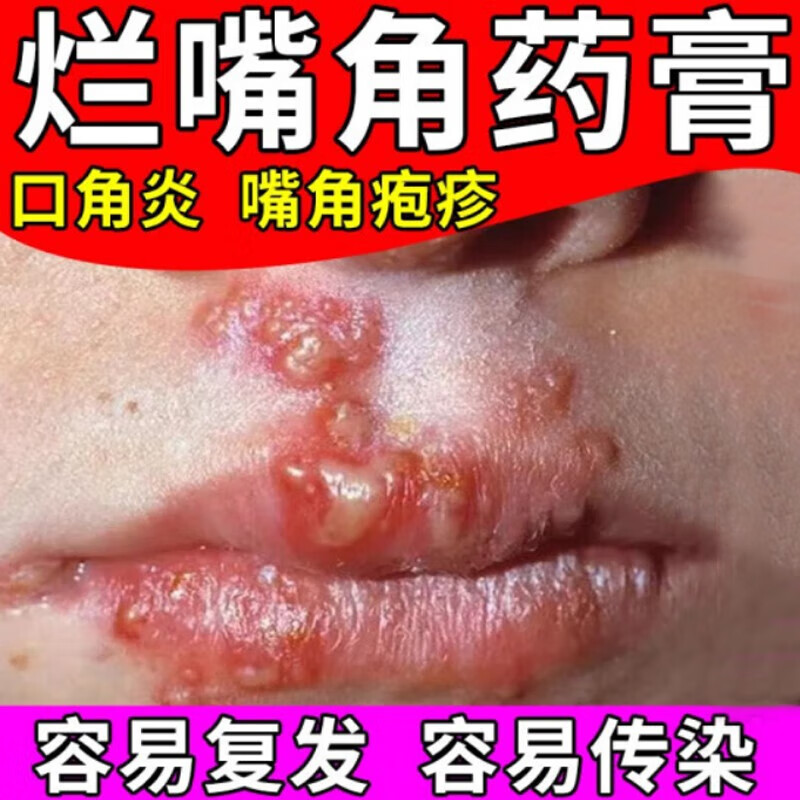 嘴唇疱疹上火起泡干裂脱皮发痒起水泡脓疮白点口角炎烂嘴角药i膏 一