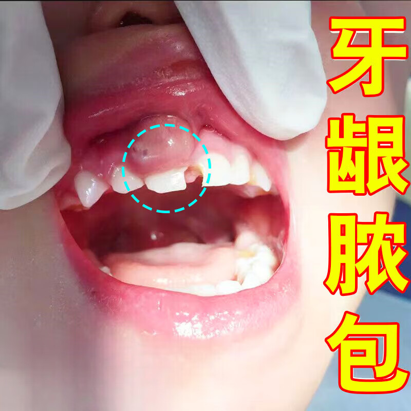 牙龈脓包肿包肿痛发炎起包红肿喷雾牙周炎口臭流脓 单盒【体验装】