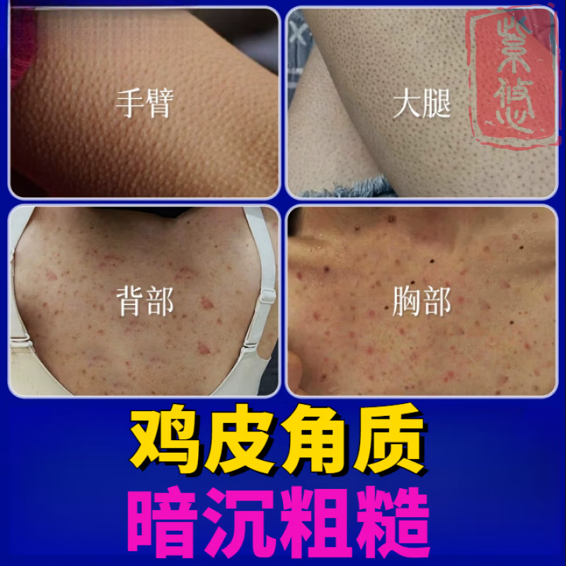 鸡皮肤疙瘩毛囊角化症成人专用非去除膏非药品鸡皮肤毛囊角质疙瘩大腿