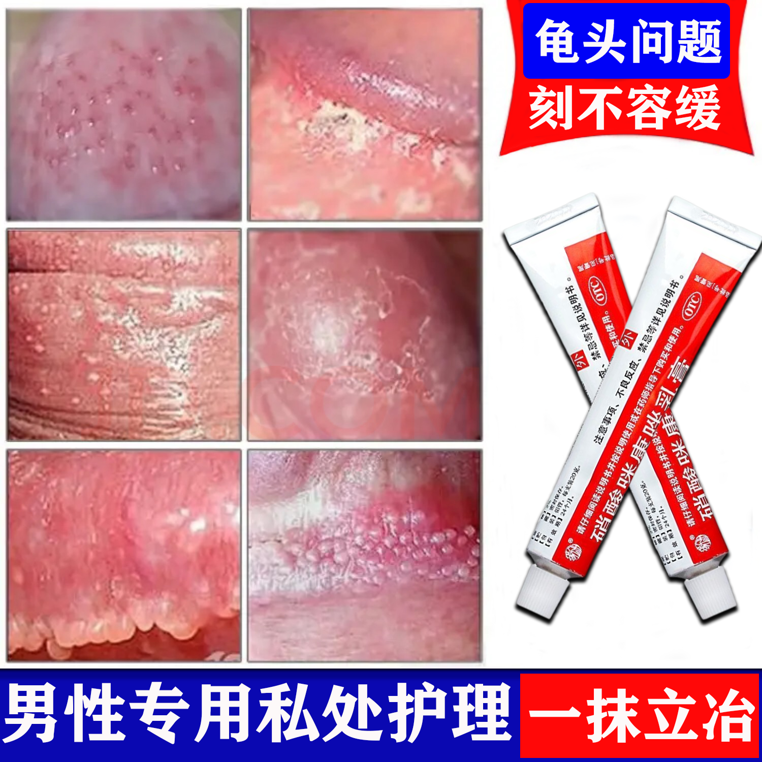 龟头炎专用药真菌感染念珠菌男性包皮炎症专用药治疗龟头疱疹私处止痒