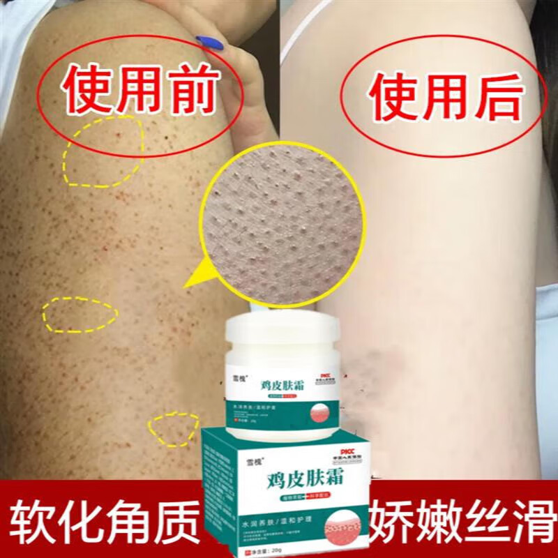 去鸡皮肤毛囊角质疙瘩大腿 手臂毛周角化症鸡皮肤去除神器软化角质