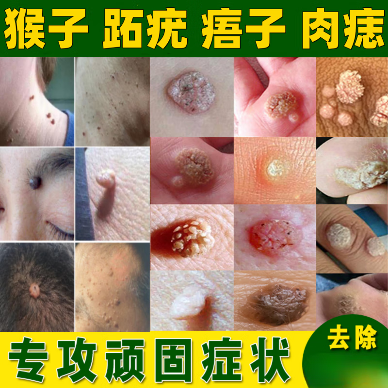鱼鳞痣专用膏疣瘊灵去除脖子小肉粒刺猴除猴子肉粒疙瘩鱼鳞痣药手脚上