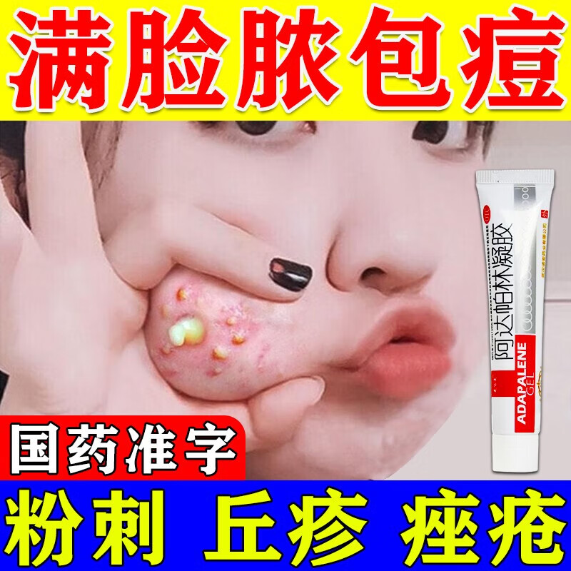 治疗座疮脸上长痘痘的药 痤疮膏 脓疱疮粉刺痘痘药膏 小颗粒痘痘皮肤
