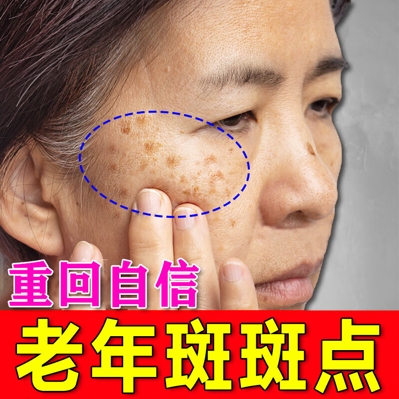 斑淡化黑色素老年斑雀斑黄褐斑手上脸上斑点提亮肤色脸部美白祛斑霜