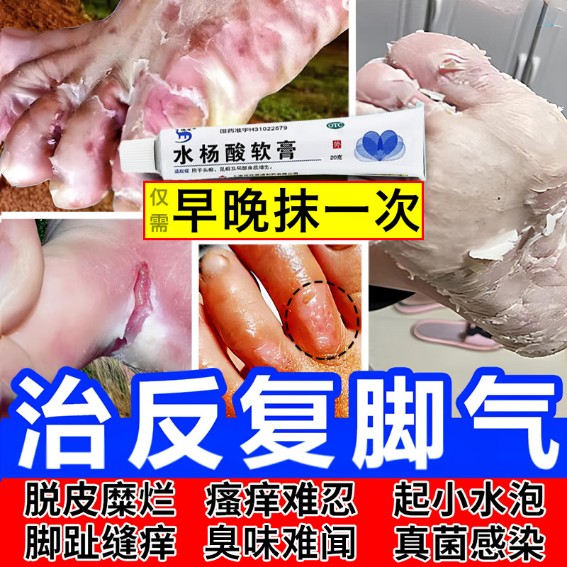 水杨酸软膏治脚气的特痒药效脚气膏止痒脱皮烂脚丫脚气根据说明书治