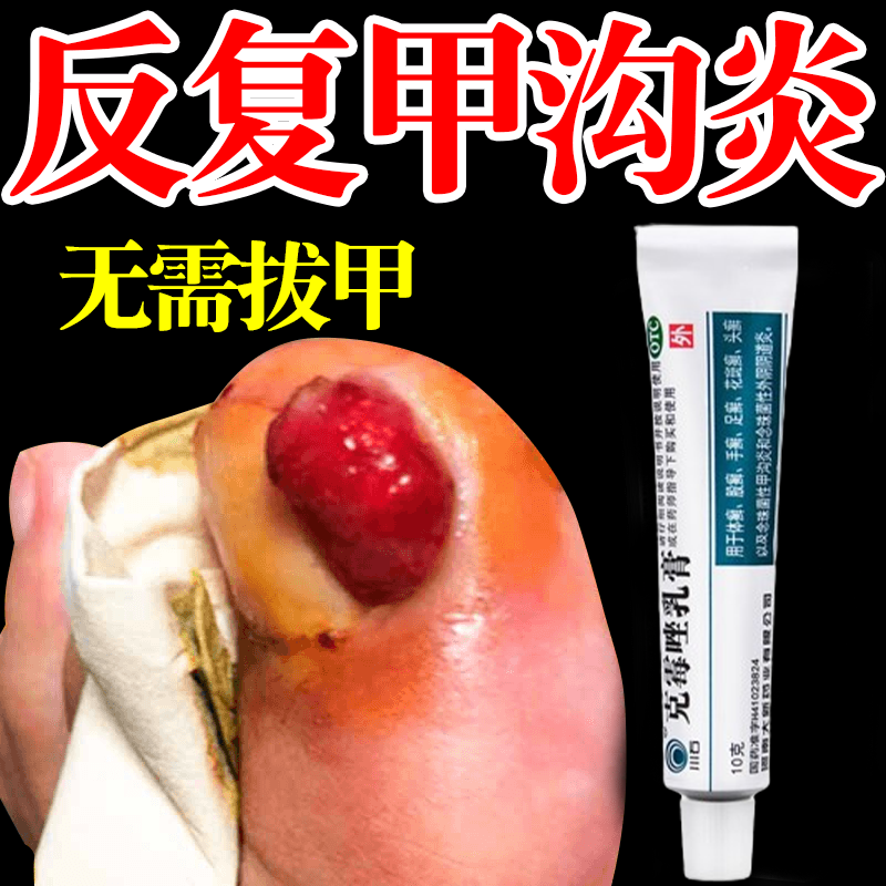 甲沟炎专用otc药甲沟炎红肿发炎流脓息肉消肿专用药脚指甲长肉里 走路