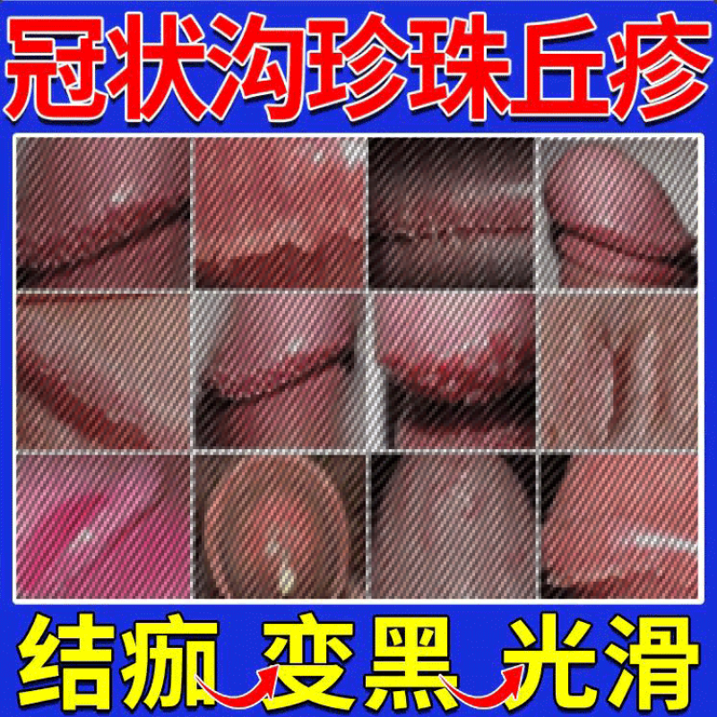 龟头炎包皮炎裂口炎症开裂发炎红肿瘙痒杀菌疱疹念珠菌真菌感染敏感