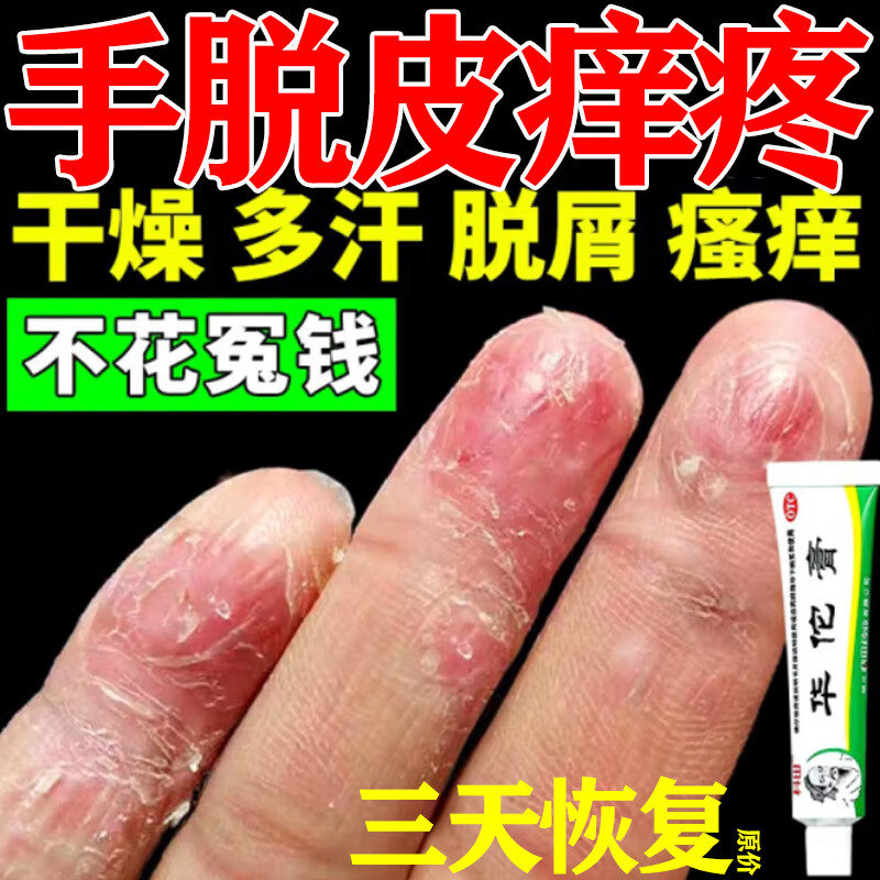 手指脱皮真菌感染 手脱皮用什么药儿童手脱皮专用药膏手癣真菌感染