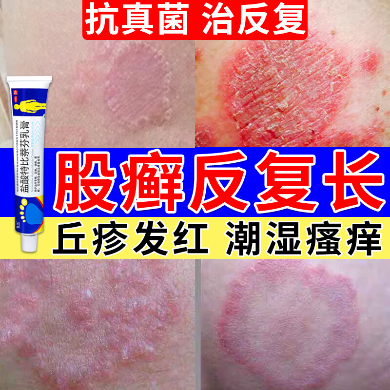 盐酸特比萘芬乳膏 股癣专用药膏大腿内侧阴囊私处瘙痒股藓大腿内真菌