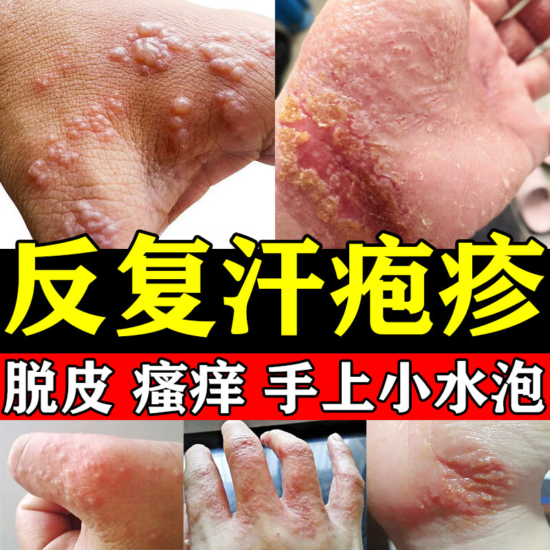 汗疱疹膏药手上长小水泡脱皮手痒汗状疱疹手指上起水泡脱皮干裂手指缝