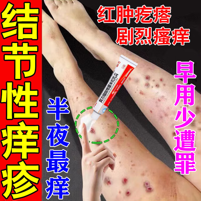 结节性痒疹专用药膏治顽固硬疙瘩皮肤瘙痒皮炎湿疹皮癣真菌感染止痒膏