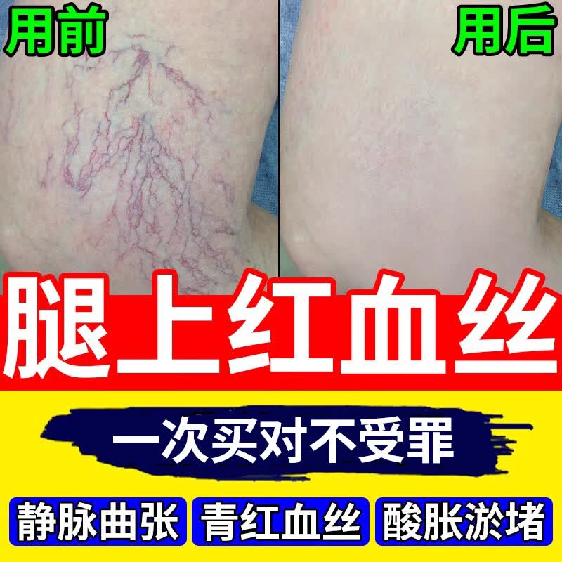 葵花腿上红血丝去除静脉曲张专用膏血管堵塞疏通药膏修复角质层腿上红 八盒【买5送3 多数顾客的选择】