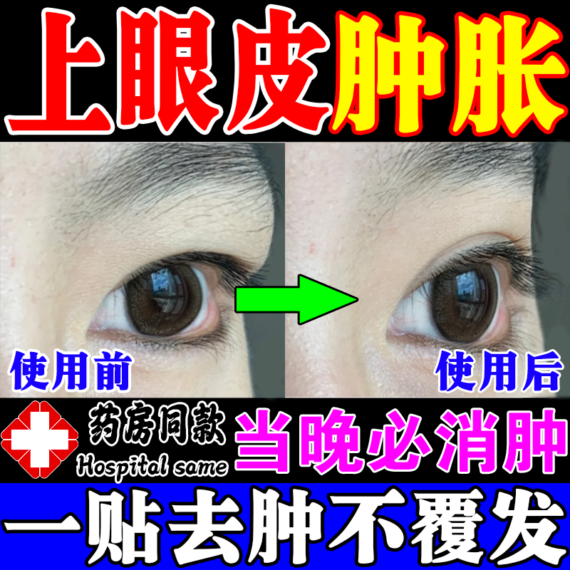 肿眼泡去脂消肿药用眼过度水肿消除眼贴去水肿眼皮松弛消肿神器 单盒