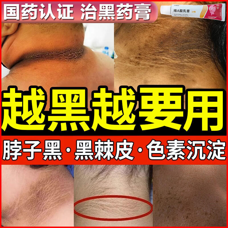 维a酸乳膏黑棘皮病治脖子黑色素去除黑色素沉淀去除唇周私处粉嫩淡化