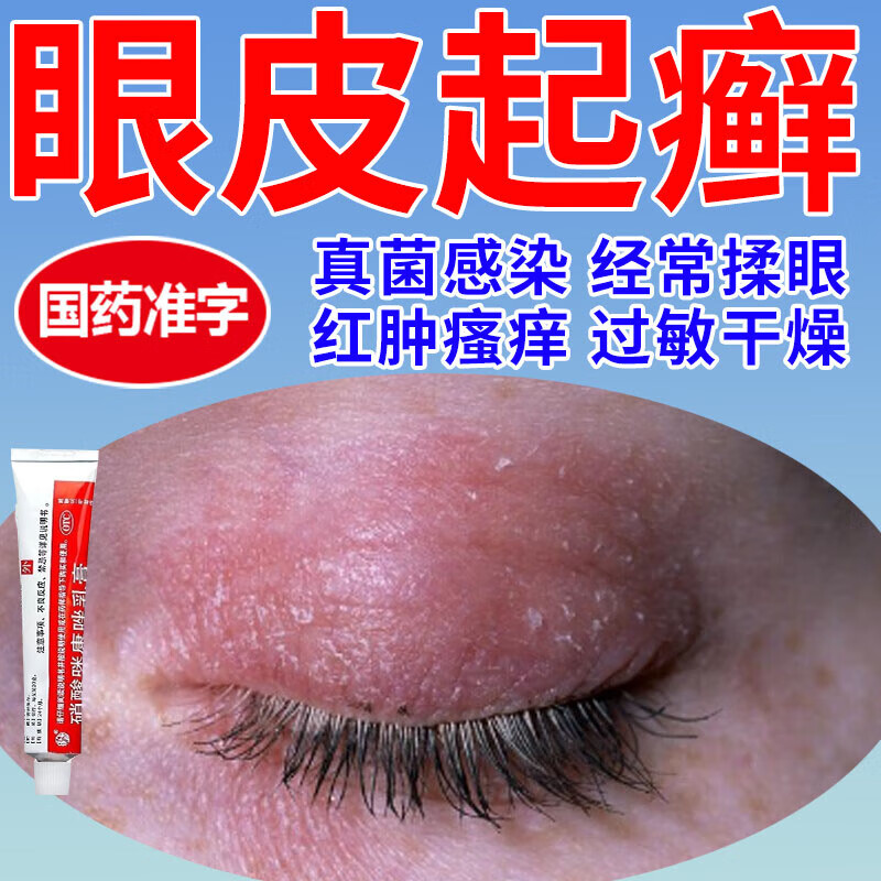 治眼皮癣 眼皮癣过敏干痒 眼皮苔癣 眼皮红肿痒过敏干燥上眼皮皮屑