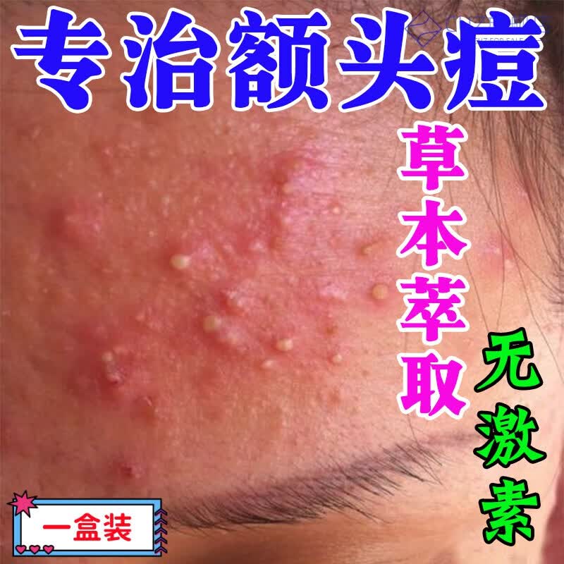 熏姿颜芝兰密语小绿管额头上长痘痘闭口脸上起小疙瘩粉刺有小颗粒脓包