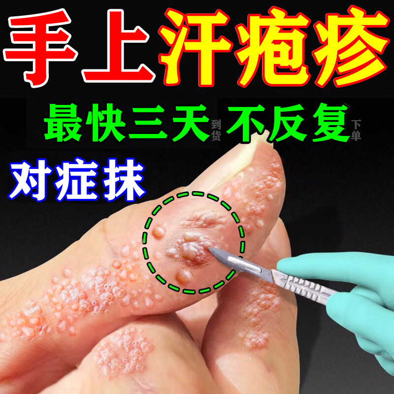 小水泡汗疱汗状疱疹抑菌膏 汗疱疹主图视觉特效药膏 皮肤瘙痒止痒膏