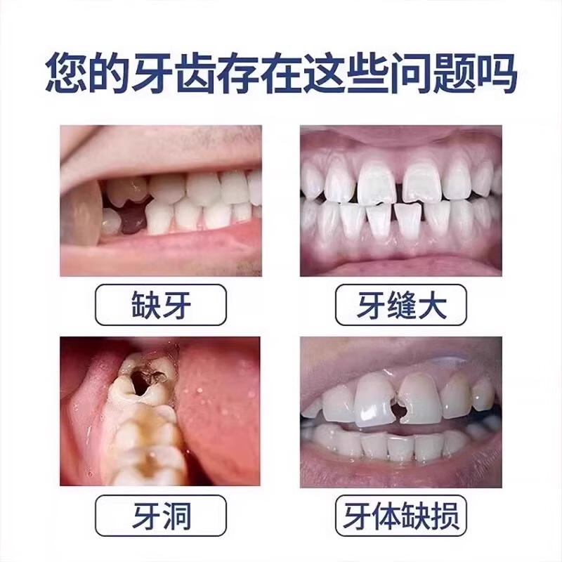 补牙材料永久自己在家补牙洞填充剂牙缝宽大修护树脂补牙材料医用 三包装【能补30颗牙】