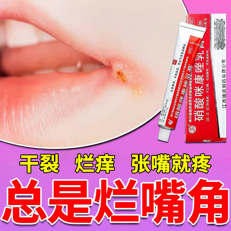 口角炎烂嘴角药膏嘴角开裂疼痛嘴角溃烂软膏口角炎专用药嘴角开裂用药