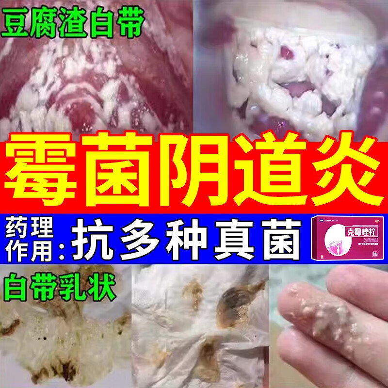 克霉唑栓剂治阴道炎妇科药品阴部瘙痒霉菌性阴道炎用药瘙痒白带豆腐渣