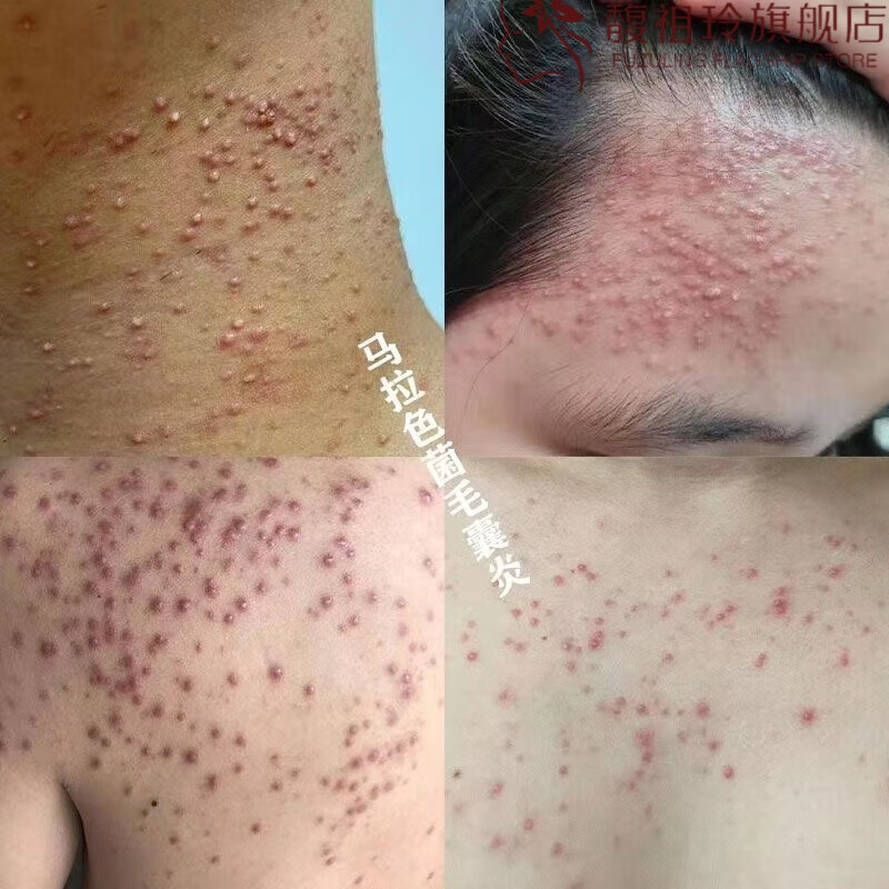 马拉色菌毛囊炎前胸后背头皮后脑勺长期毛囊堵塞脓包痘 3盒装【买2贈1