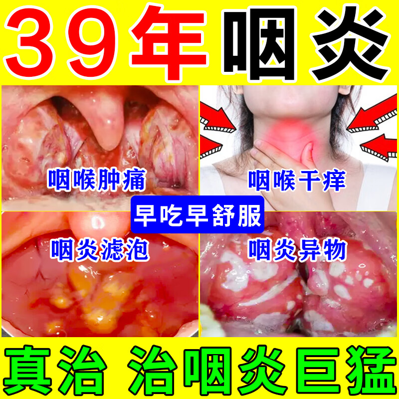 异物感 咽喉炎专用药咽炎慢性咽炎除药根 嗓子疼治喉咙痛的药消肿