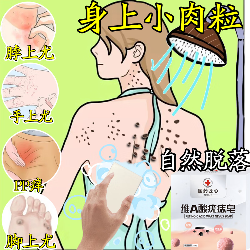 L0【国药匠心-维A酸疣痣皂】全身小肉粒扁平尤丝状尤瘊抑菌手工香皂 国药维a酸疣痣皂-五块400g.