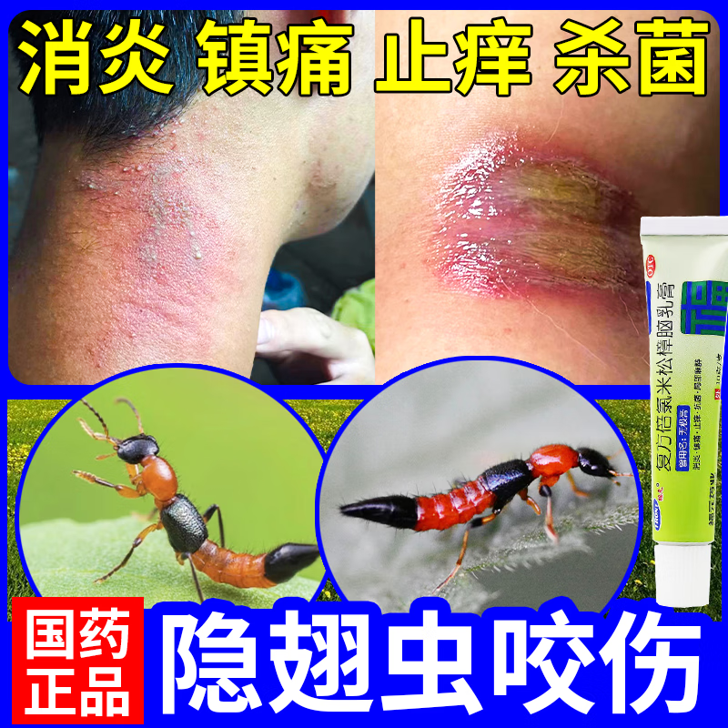 隐翅虫叮咬专用药膏】蚊虫叮咬止痒消肿虫咬性皮炎红肿疼痛瘙痒片状