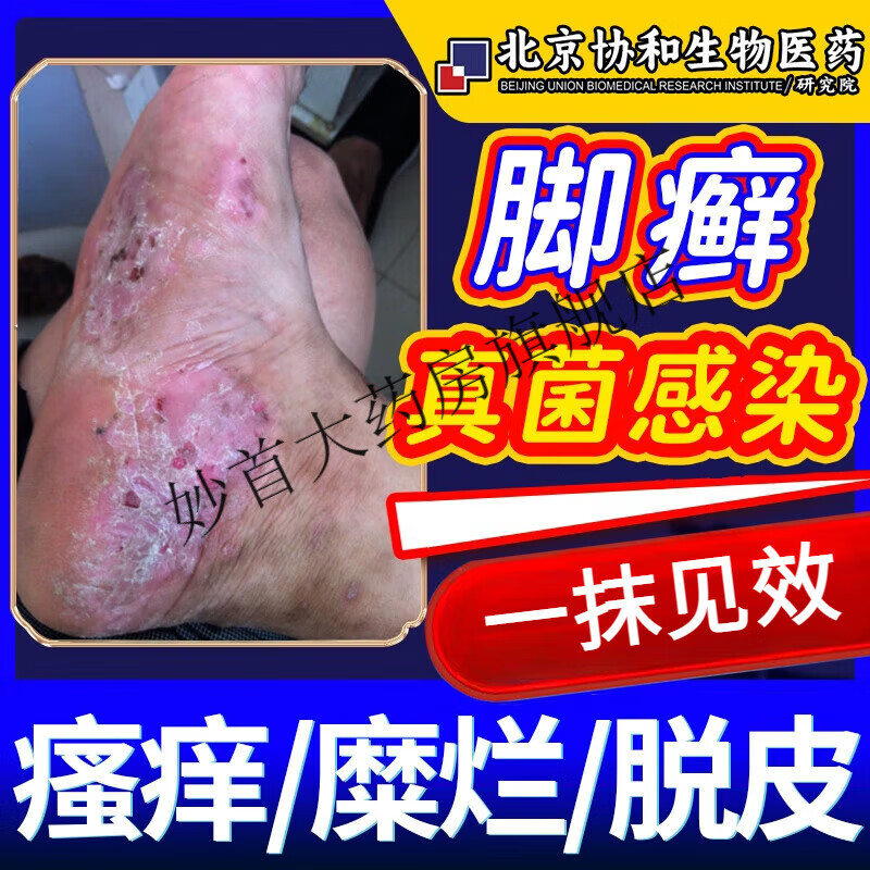 脚癣一次净老牌子脚癣一次净专用膏有药监备案特傚效真菌感染脚气膏