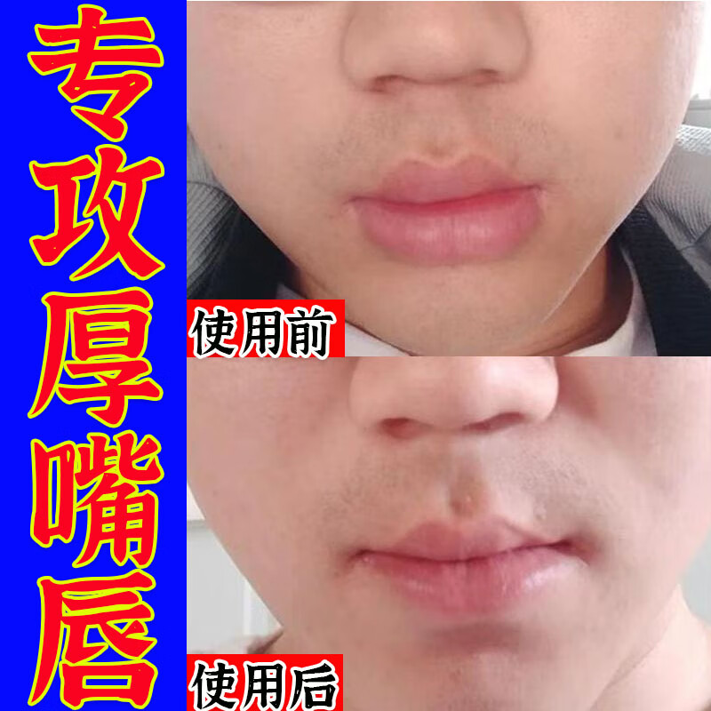 厚嘴唇变薄改善外翻改善香肠嘴凸缩小嘴巴嘴唇厚发黑嘴唇变薄变小 20g