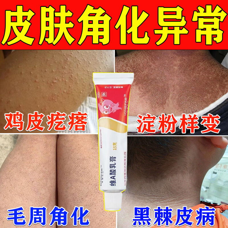 症专用药鸡皮疙瘩瘙痒去除手臂胳膊上腿上的小疙瘩大腿毛周角化症药膏