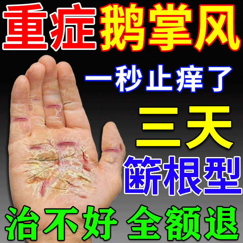 鹅掌风专用手癣真菌感染止痒抑菌足癣脱皮开裂手起水泡特傚效药膏 单