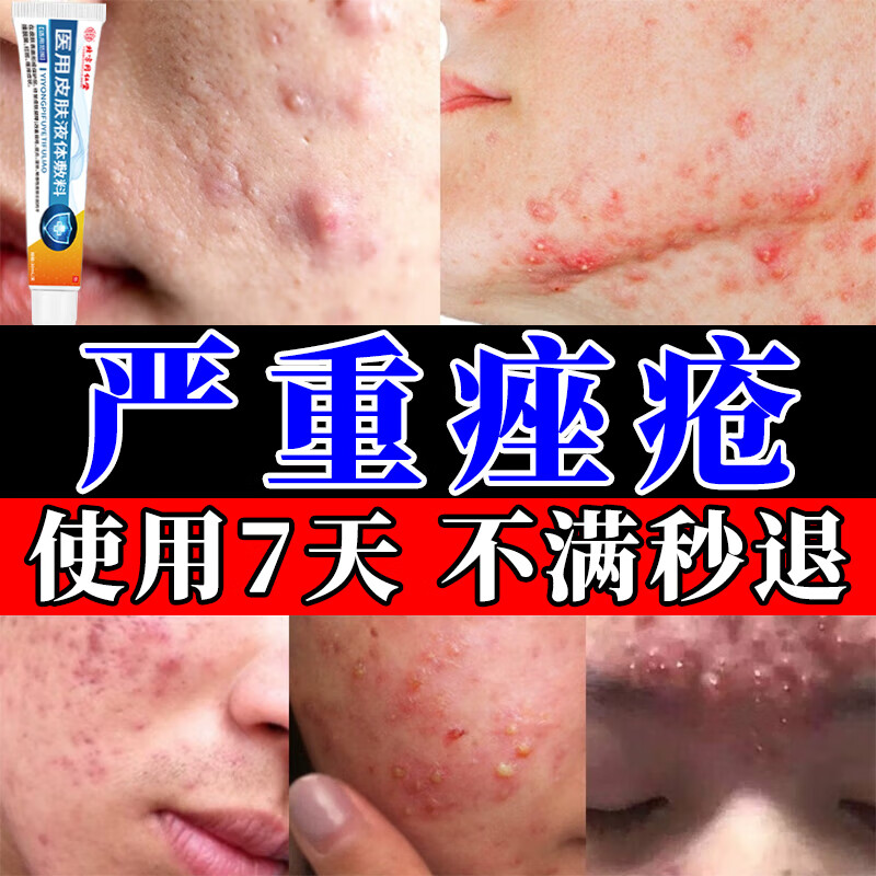 北京同仁堂 痤疮膏重度暗疮男女初中生腮边青春痘脸上额头下巴起小疙瘩痤疮膏专用痤疮凝胶 一盒装【30ml/盒】 京东折扣/优惠券