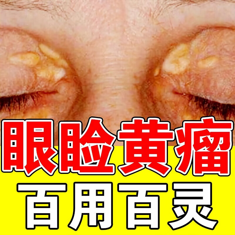 药房直售治眼睑黄瘤元康软膏眼部汗管瘤脂肪瘤黄斑凸起去除眼角 单