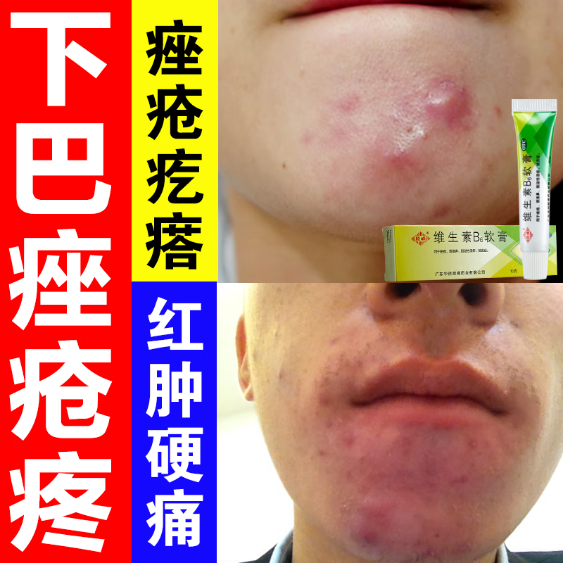 下巴长疙瘩 下巴硬疙瘩 下巴长痘油腻红肿 下巴红肿硬痘痘祛痘消炎