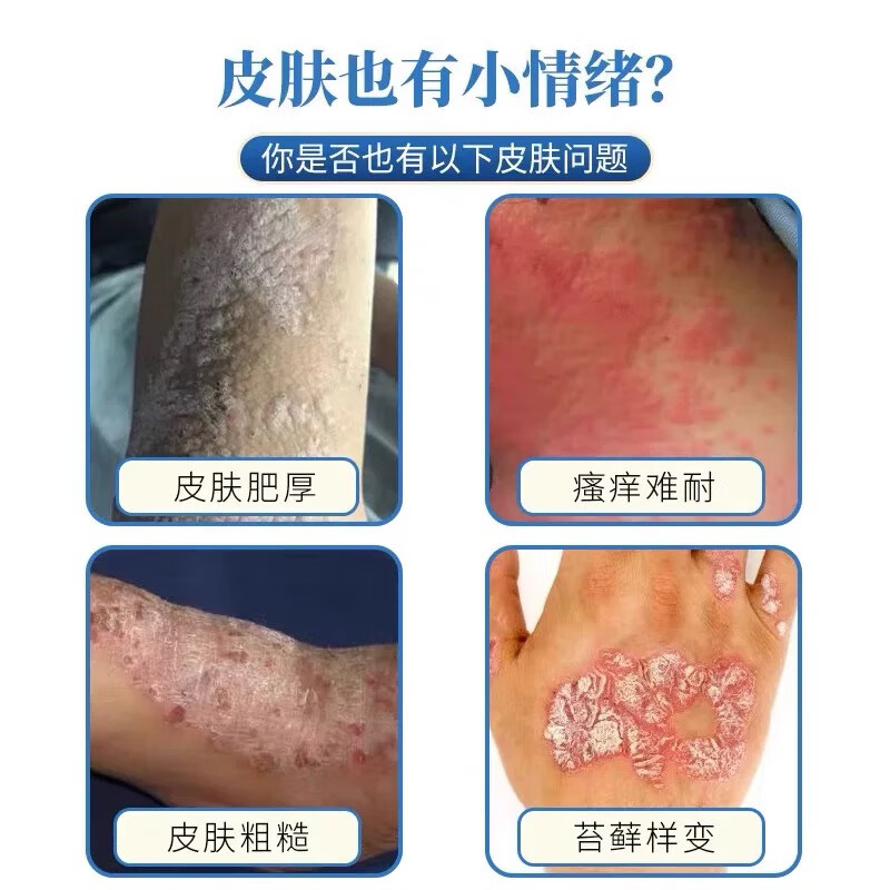 金志龙脖子上长片癣痒药膏红痒刺挠颈部上起红疙瘩过敏神经性皮肤止痒膏 发五盒【买三送二深层巩固装】