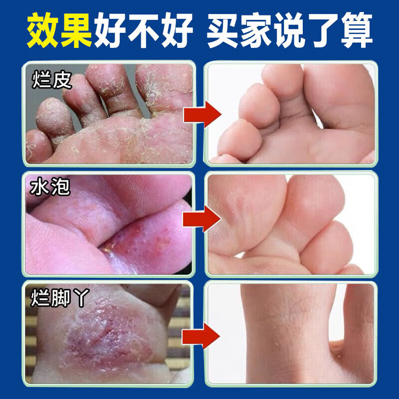 战立克脚气喷剂套装止痒脱皮烂脚丫真菌感染去水泡型脚痒脚汗脚臭喷雾根 【2盒装】足康喷剂套装